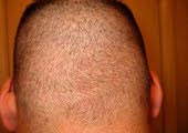 The following picture shows a scalp donor area as it appears at only 6 days after Dr. Umar removed 2300 grafts by FUE