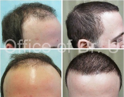 Hair Restoration by FUE and BHT before and after