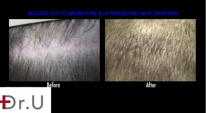 Repair of Strip Scar| Before & After Insertion of Beard Hair