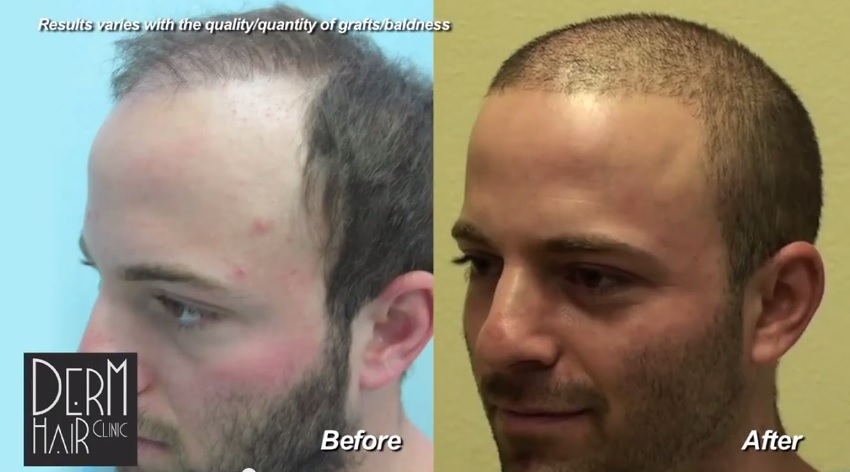 Three Quarters View of Patient's Results| Youthful Transformation