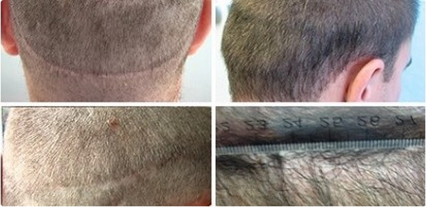 Follicular Unit Extraction FUE in the United States, result of strip surgery scar repair by UGraft FUE