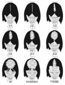 Female Savin Scale for Hair Loss Savin scale showing the levels of female pattern baldness.