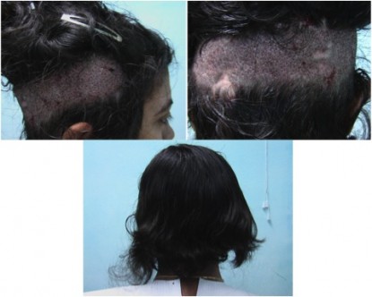 Women and hair transplants: Example of the considerations taken to conceal the shaved donor area in women.