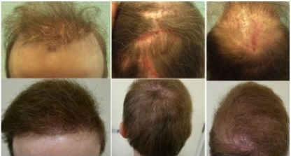patient before and after his UGraft Hair Transplant repair which successfully repaired the cumulative results of past surgeries