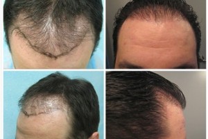 Hair Restoration Testimonial by B. C