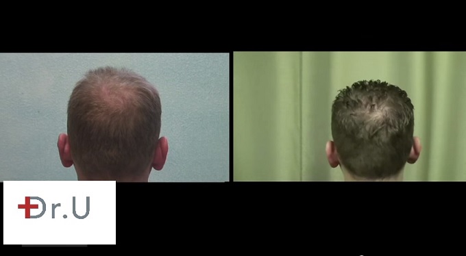 FUE Crown Hair Restoration| Before and After - 18 Month Point