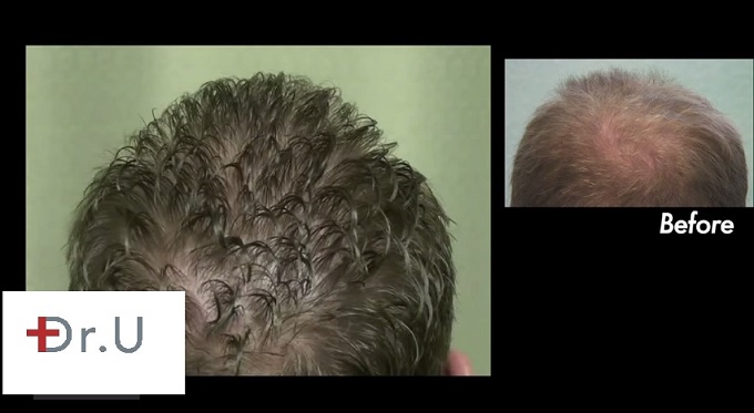 FUE Restored Crown| Improved Density at 18 Months