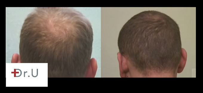 Crown Hair Restoration | Follicular Unit Extraction