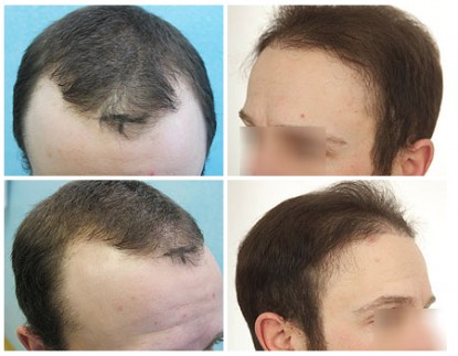 FUE Hair Restoration Using 3500 grafts to Front and Crown Areas