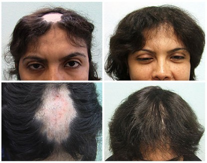 FUE Hair Transplant for Lupus DLE