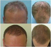 FUE Hair Transplant Using 3500 grafts