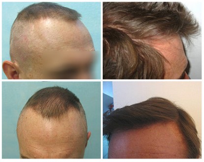 FUE Repairs Strip Surgery , natural hairline reconstruction