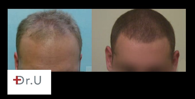 Patient's New Hairline and Temples| Before and After