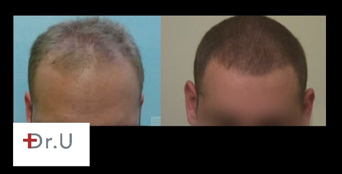 Patient's New Hairline and Temples| Before and After Patient's New Hairline and Temples| Before and After