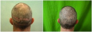 FUE SURGEON Dr U's patient before and after strip scar camouflage with beard to head transplant