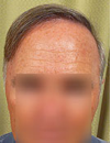 Reversal of Graying Hair After Transplantation