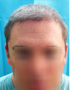 After restoring Hair Loss Level NW6 to NW0 with UGraft Advanced FUE