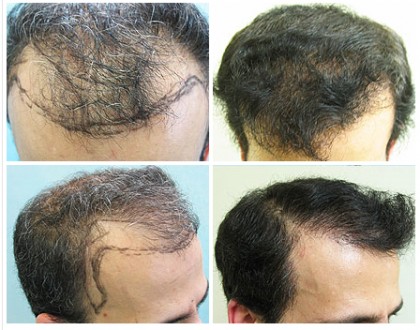 Hairline Transplantation Using Nape, Beard and Chest Hair Only before and after photos
