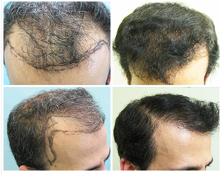 Hairline Transplantation With Nape, Beard and Chest Hair
