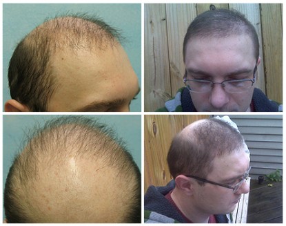 UGraft Body Hair To Head Transplant Repair of Previous Hair Restoration And Strip Scar