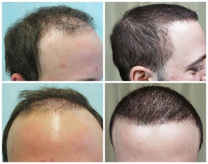 Body Hair to Head Transplant Using 5800 grafts photos