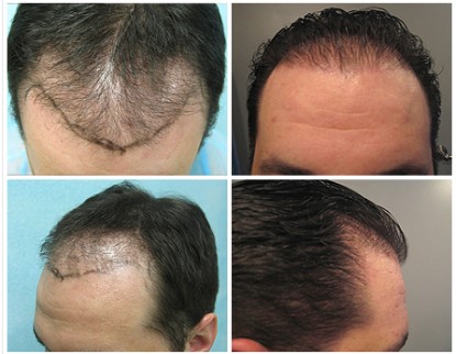 Hair Restoration Repair Using Follicular Unit Extraction