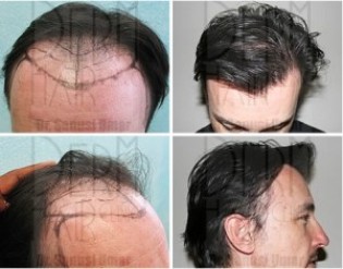 Follicular Unit Extraction Using 4600 Grafts 