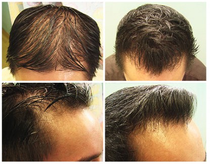 Asian Follicular Unit Extraction 1500 grafts