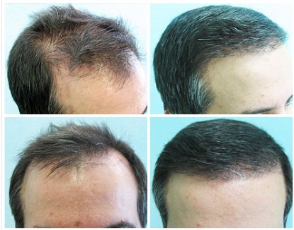 Body hair Transplant Using 5000 grafts for Density and Hairline Restoration, before and after photos