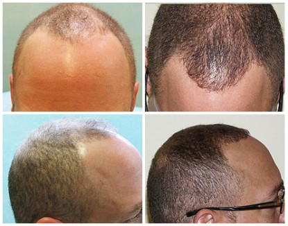 African American FUE Hair Transplant Using 1200 grafts , before and after photos