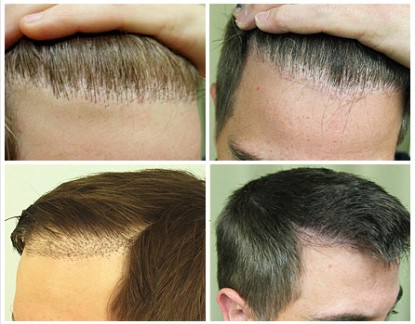 Hairline Repair Surgery Using by UGraft FUE before and after photos