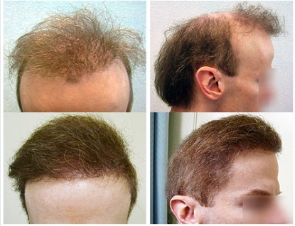 Worst Case hair transplant repair Using UGraft restores Hope
