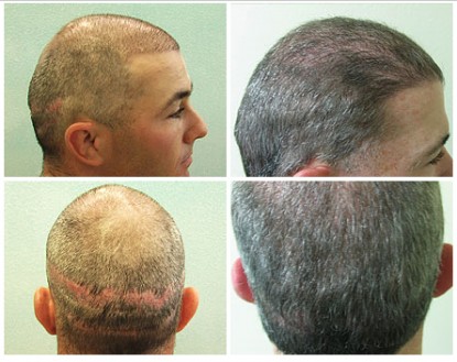 Ugraft FUE Hair Transplant for Repairing Poor Strip Hair Surgery Results