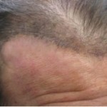 BHT Hair Repar for Disfigurements 