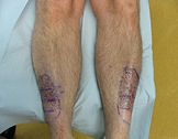 Leg Hair Restoration for leg or shin hair loss