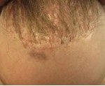 BHT Hair Repair for Disfigurements - pluggy hairline correction