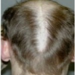 BHT Hair Transplant Repair - Before slot deformity repair