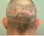 BHT Hair Transplant 