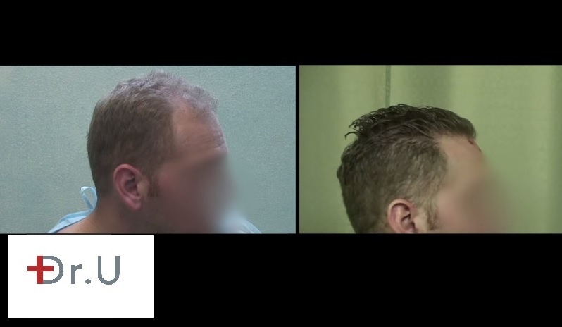 Temple Hair Restoration|FUE Results - Before and After