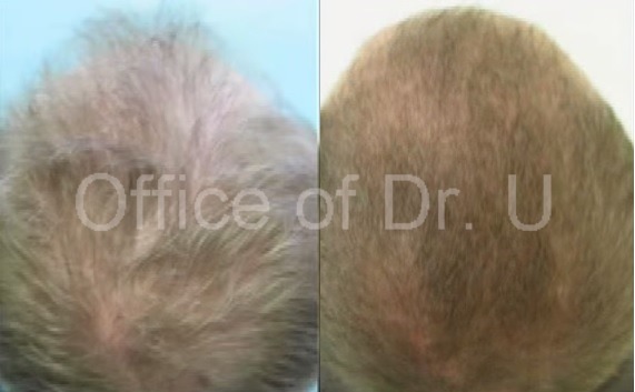 FUE Hair restoration Using 3,500 Grafts - before and after photos