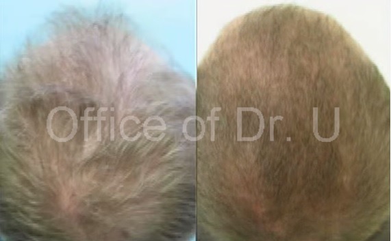 FUE Hair restoration Using 3,500 Grafts - beofre and after photos FUE Hair restoration Using 3,500 Grafts - before and after photos