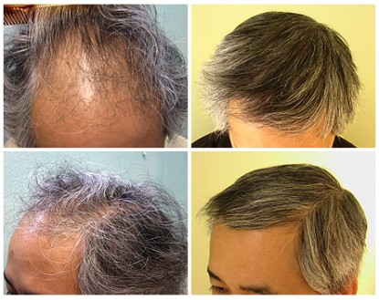Asian FUE Hair Transplant Using 3000 Grafts