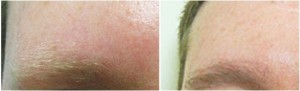 Eyebrow Transplantation Using Follicular Unit Extraction