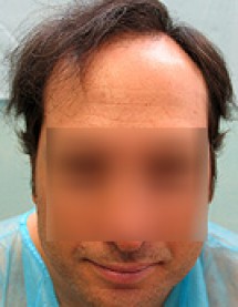 Fixing Hair Loss with FUE Hair Transplant Method Fixing Hair Loss with FUE Hair Transplant Method, crown baldness