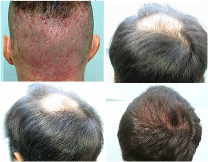 Fixing Hair Loss with FUE Hair Transplant Method