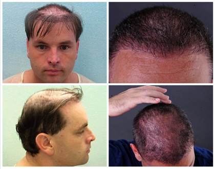 Botched Hair Surgery Repair Through Head and Body Hair before and after photos