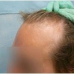 Receding hairline due to male pattern baldness. 