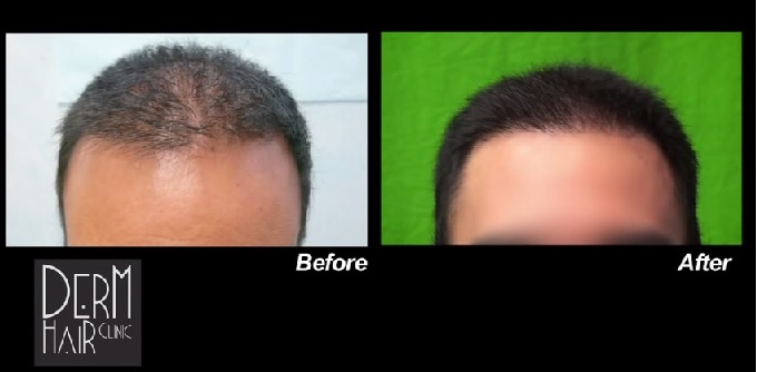 UGraft FUE Hair Transplant Hairline Softening with Nape hair by Dr U 