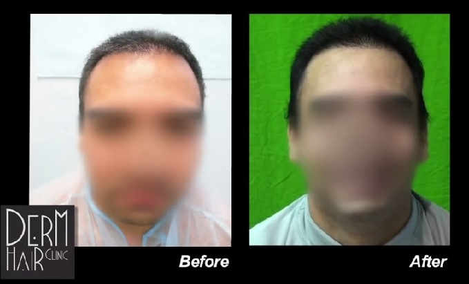 Patient's New Hairline and Temples| Full Face View