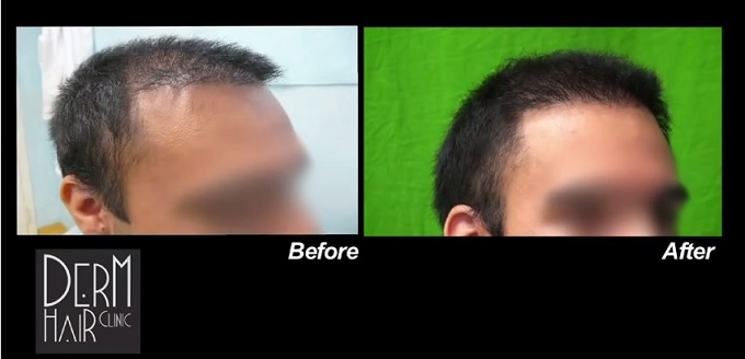 UGraft FUE Hair Transplant Hairline Softening with Nape hair by Dr U - View of Patient's Temples
